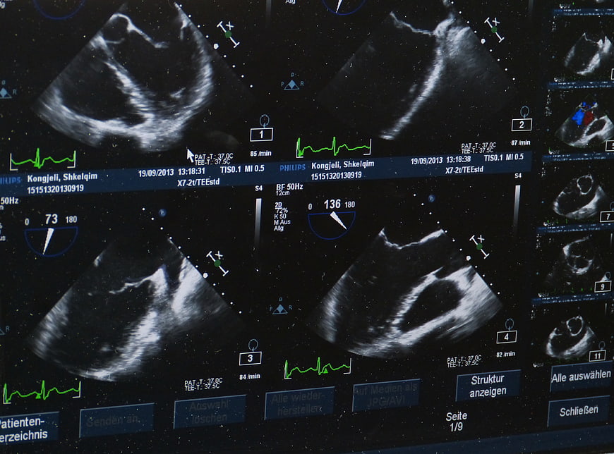 Multi-view medical ultrasound monitor screen displaying cardiac imaging data