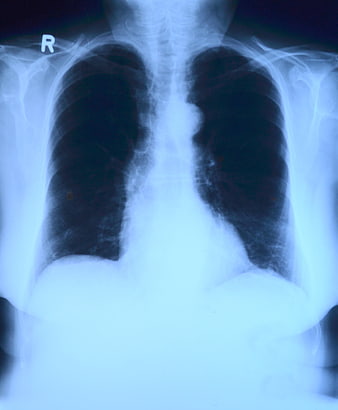 Chest X-ray showing lungs, ribs, and heart shadow