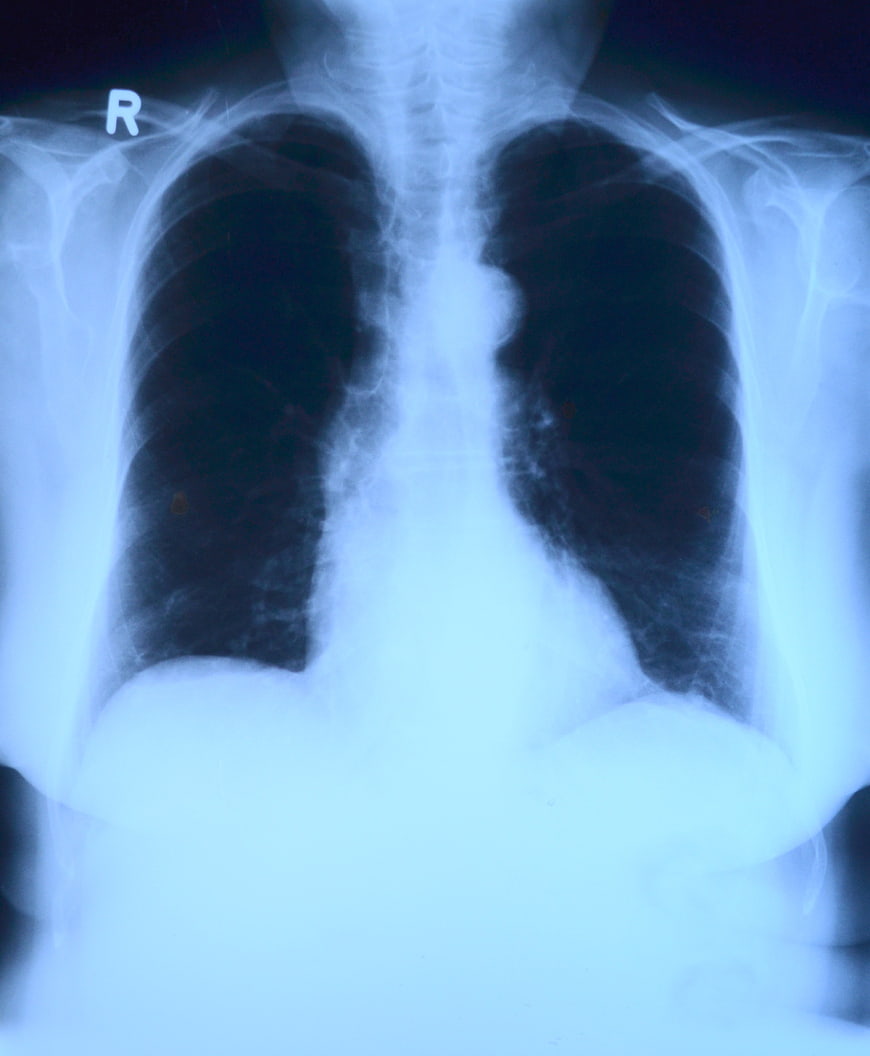 Chest X-ray showing lungs, ribs, and heart shadow