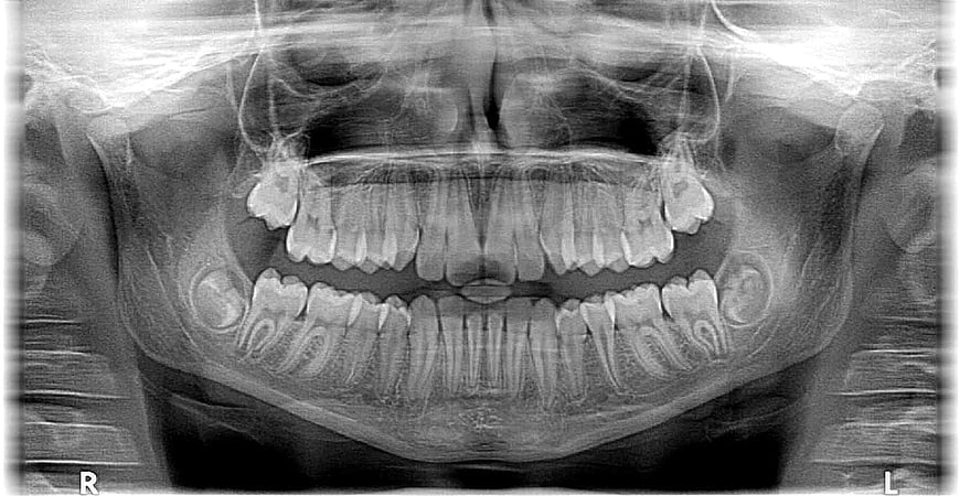Dental Panoramic X-Ray Showing Full Jaw Structure and Teeth