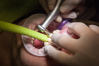 Close-up of dental procedure with drill and suction tube