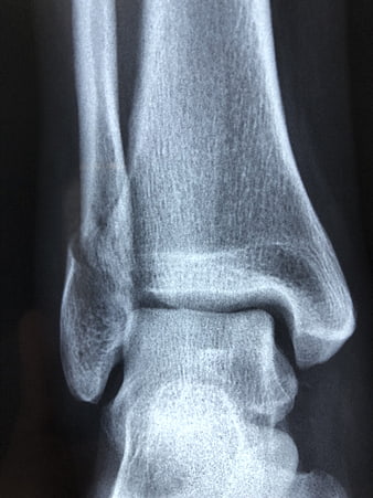 X-ray of human ankle joint showing bones