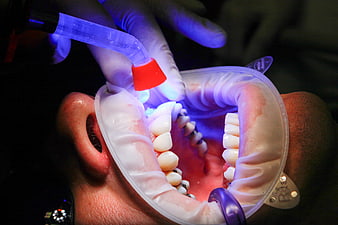 Dental curing light hardening composite filling on teeth