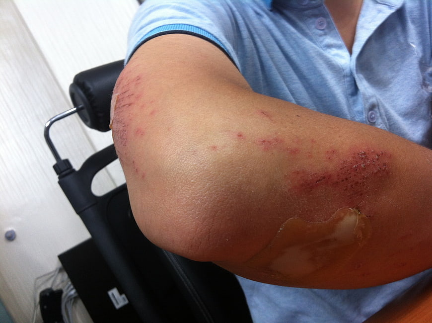 Close-up of scraped elbow with abrasions and medical dressing