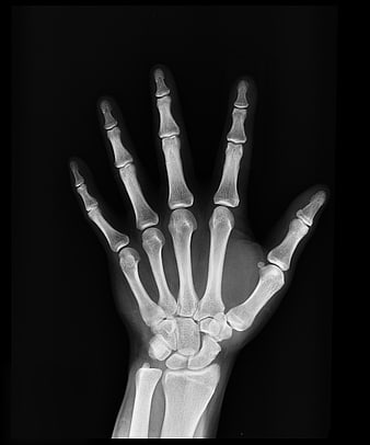 X-ray of Human Hand and Wrist Bones