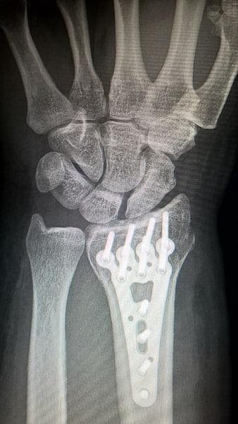 X-ray of wrist with titanium plate and screws for fracture fixation