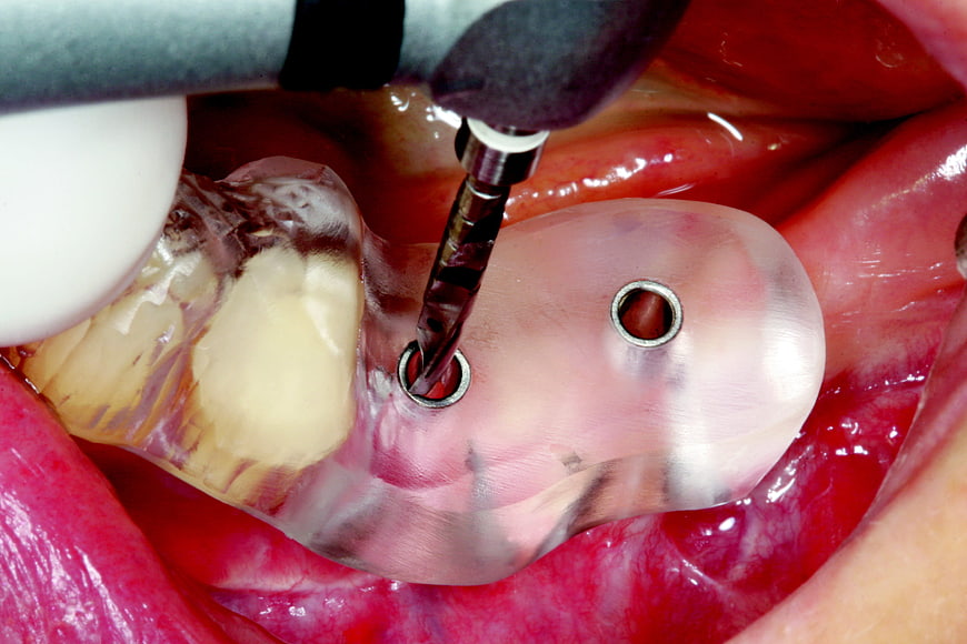 Dental implant surgery with surgical guide and drill
