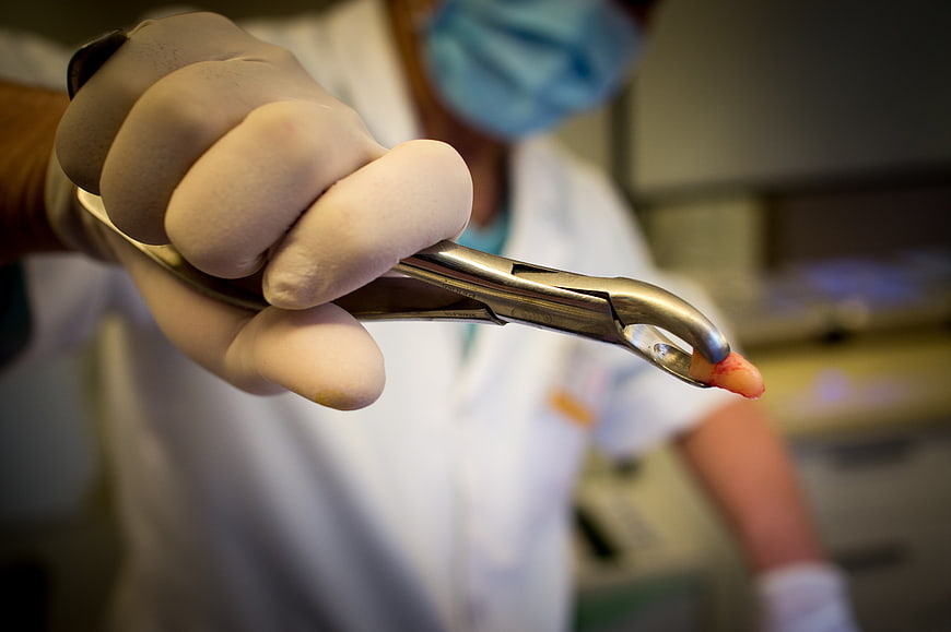 Dentist Holding Extracted Tooth With Forceps In Clinic