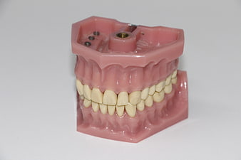 Dental implant model with artificial teeth and pink gums