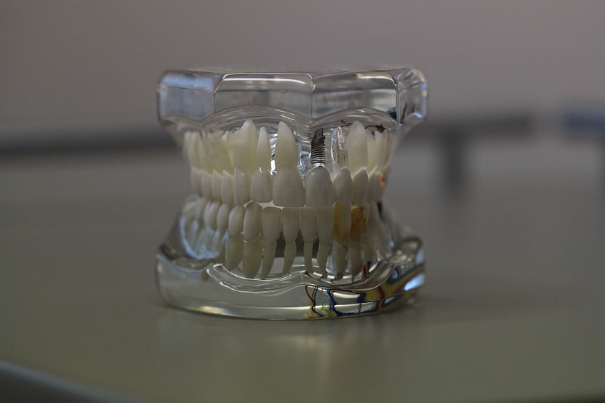Dental Implant Model with Teeth and Jaw Structure