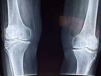 X-ray of knee joint showing bone structure and anatomy