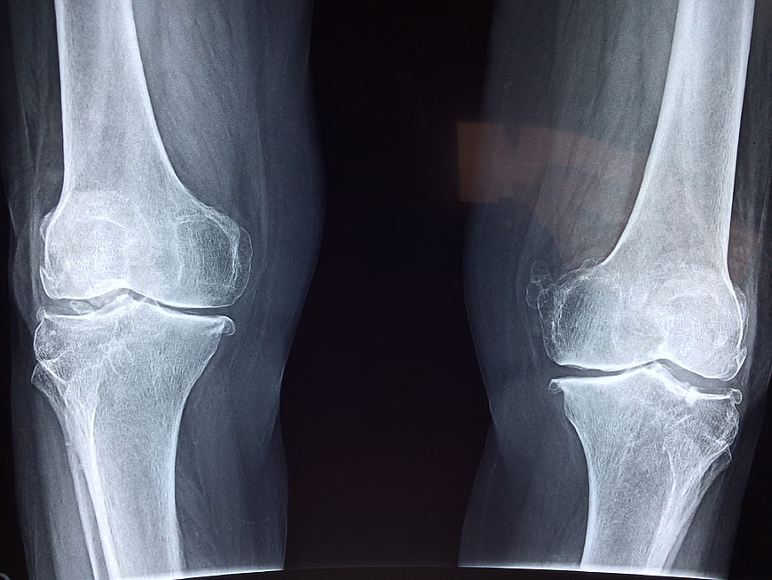X-ray of knee joint showing bone structure and anatomy