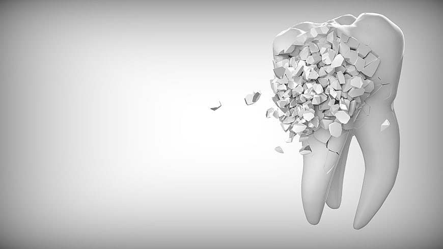 3D Render of Cracked and Shattering Molar Tooth