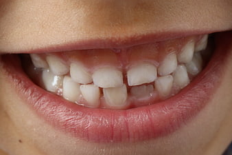 Close-up of child's mixed dentition teeth and gums