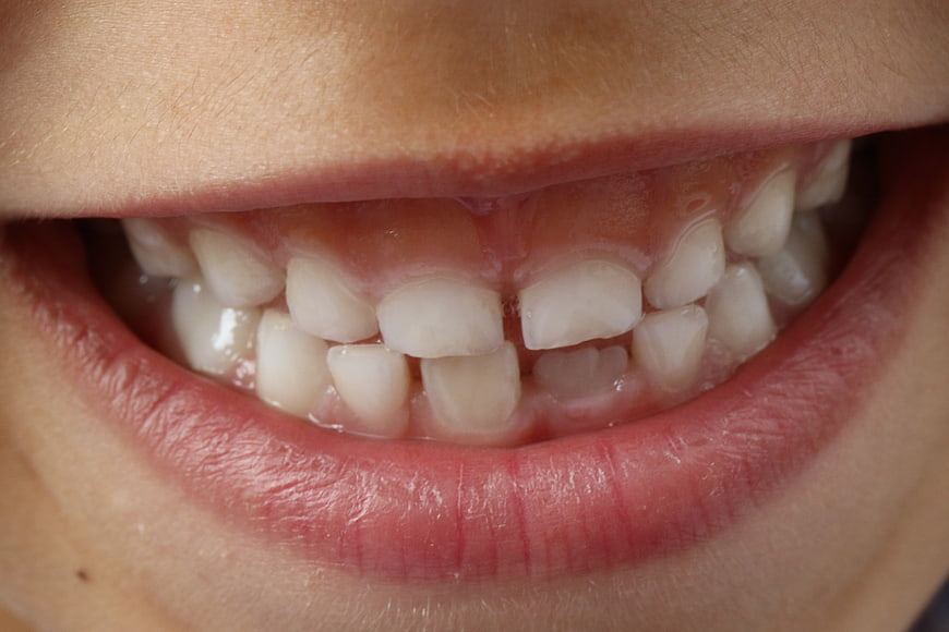Close-up of child's mixed dentition teeth and gums