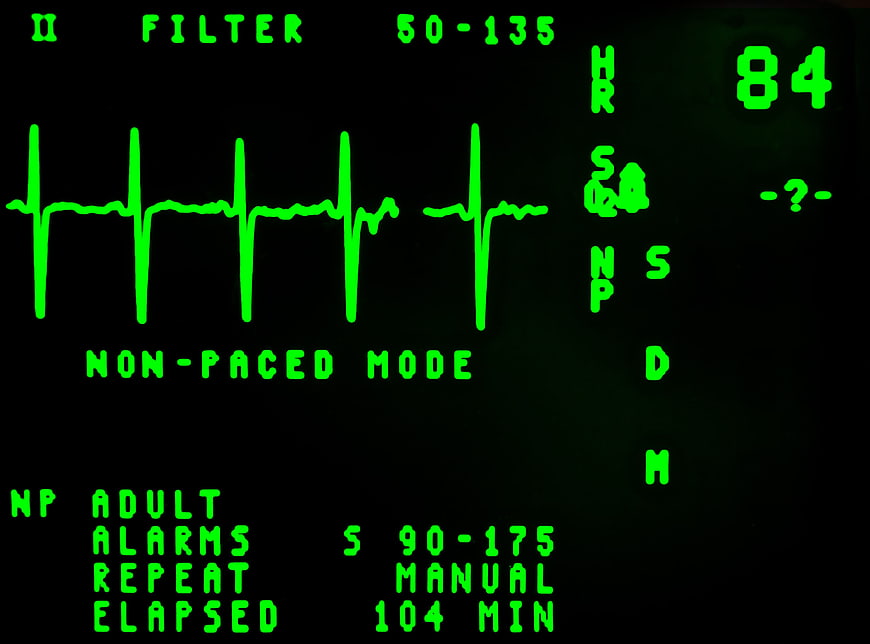 Green ECG Heart Monitor Display on Black Background
