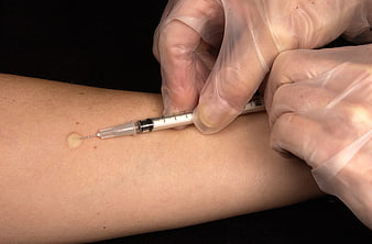 Close-up of Tuberculin Skin Test Injection on Arm