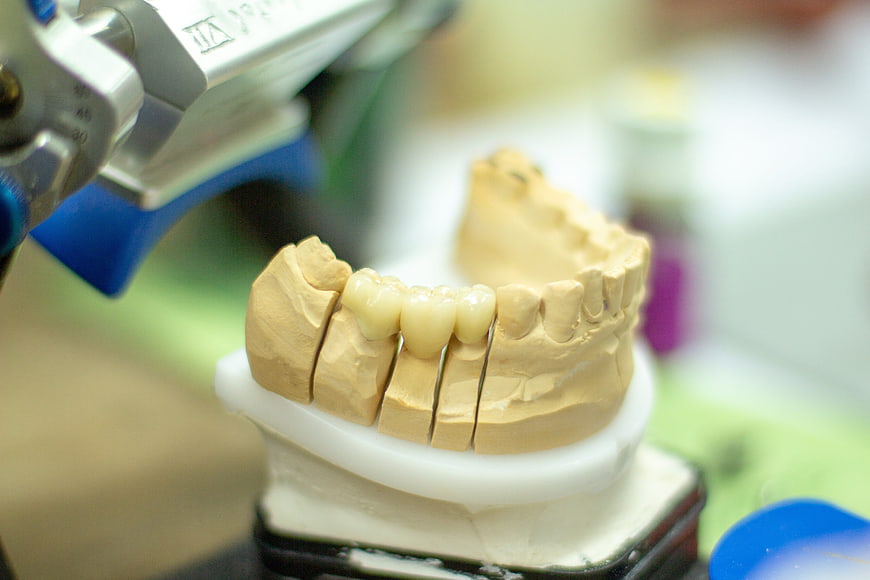 Dental articulator with ceramic denture model in laboratory
