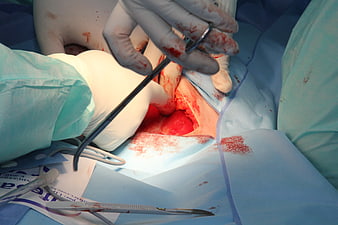 Close-up of surgical procedure with gloved hands and medical instruments