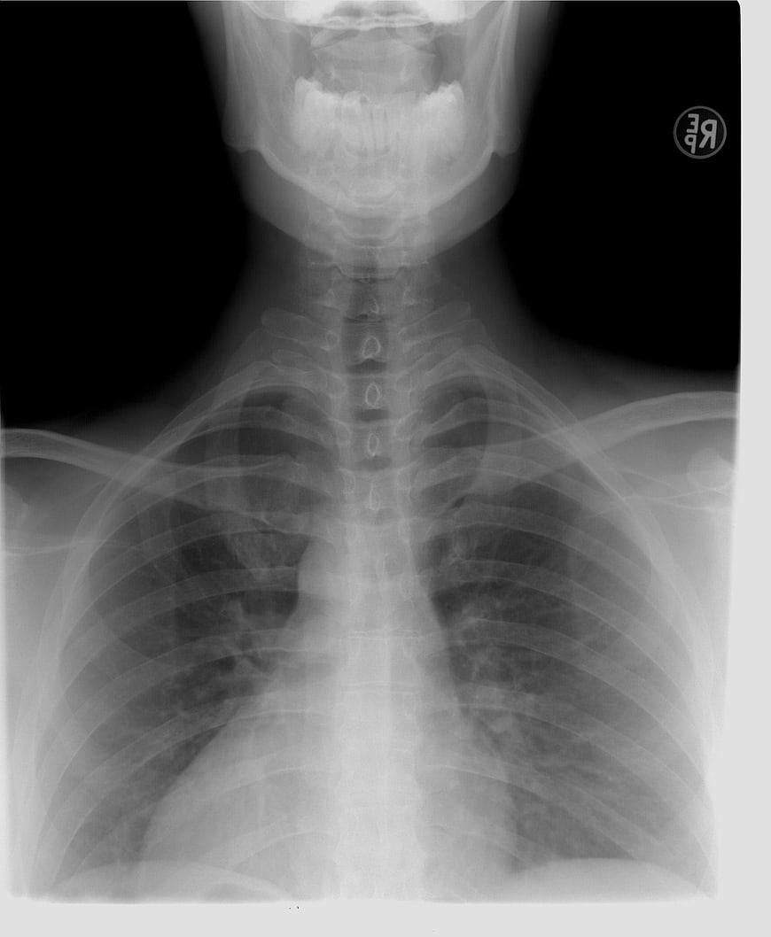 Chest X-Ray Radiograph Showing Thoracic Spine and Rib Cage