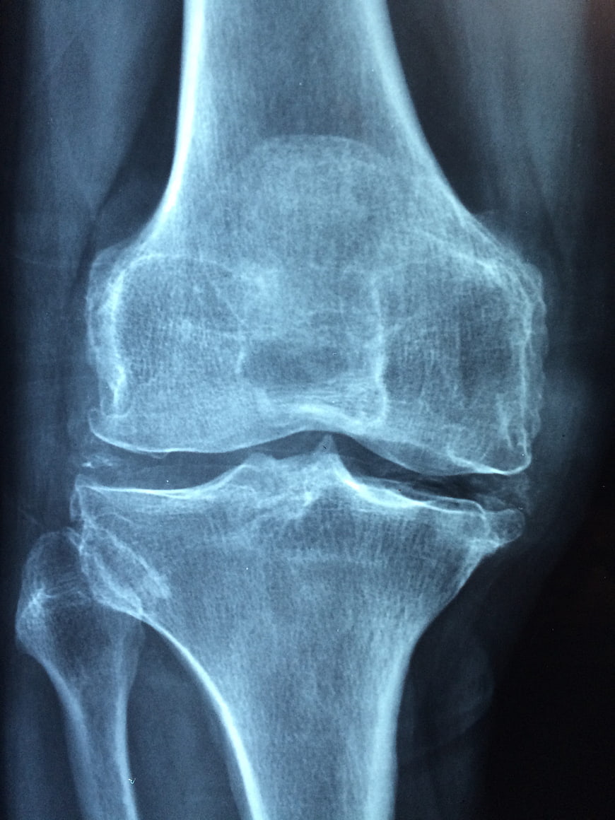 X-ray of knee joint showing osteoarthritis and bone structure