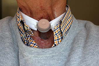 Close-up of a man's neck with a tracheostomy tube and stoma