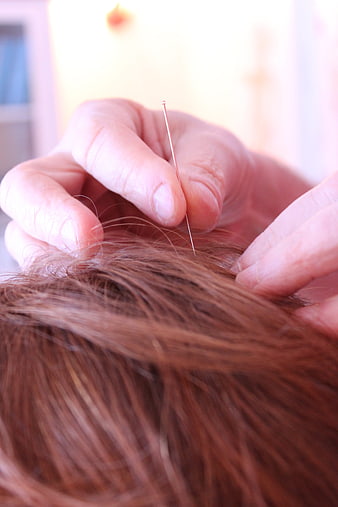 Close-up of acupuncture needle insertion into scalp hair