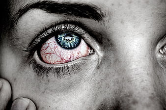 Close-up of red irritated eye with blue iris