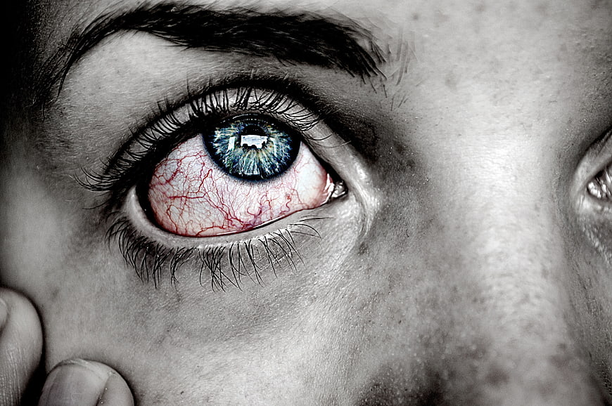 Close-up of red irritated eye with blue iris