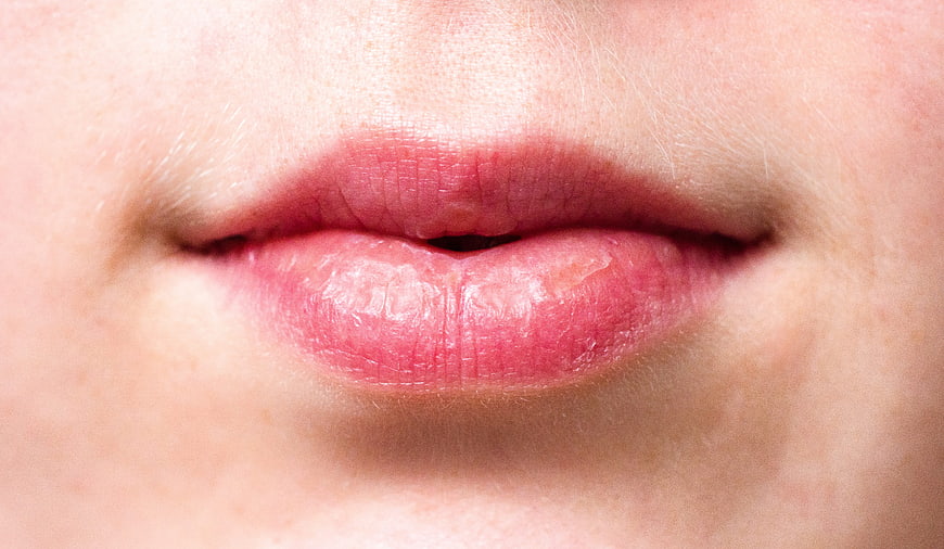 Close-up of dry chapped lips with natural texture