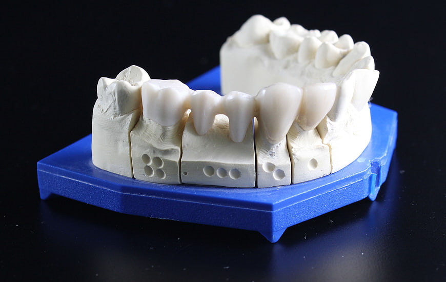 Dental Model With Implant Abutments On Blue Base