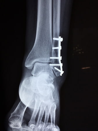 X-ray of ankle fracture with surgical plate and screws