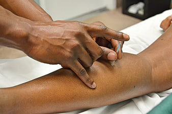 Close-up of acupuncture needle insertion on patient arm