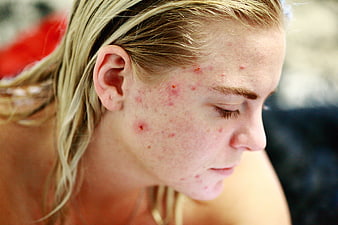 Close-up portrait of a young woman with visible acne and blemishes