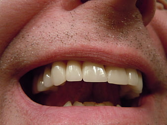 Close-up of male teeth with ceramic dental crowns