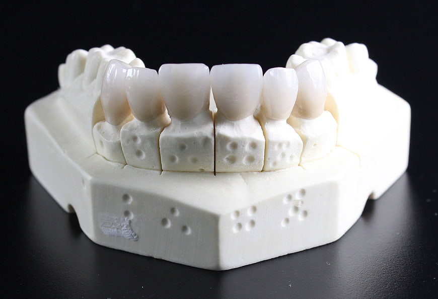 3D Printed Dental Model with Teeth on Black Background
