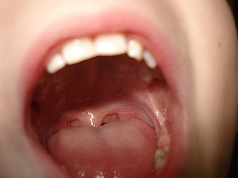 Close-up of a young boy's open mouth showing teeth and tongue