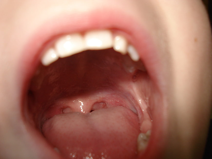 Close-up of a young boy's open mouth showing teeth and tongue