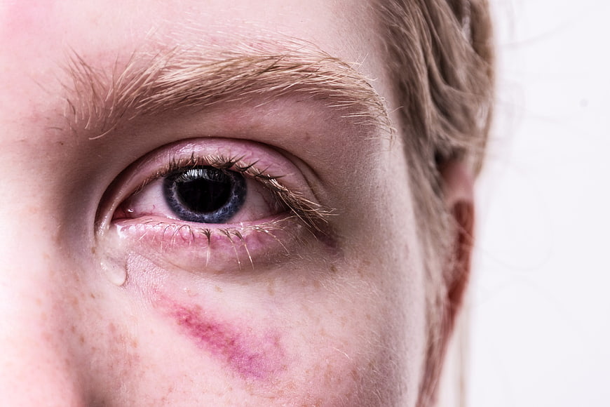 Close-up of a crying woman's eye with a bruise on her cheek