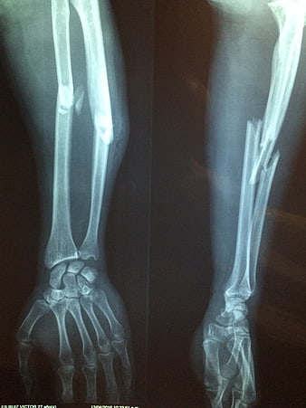 Medical X-Ray of Fractured Forearm and Wrist Bones