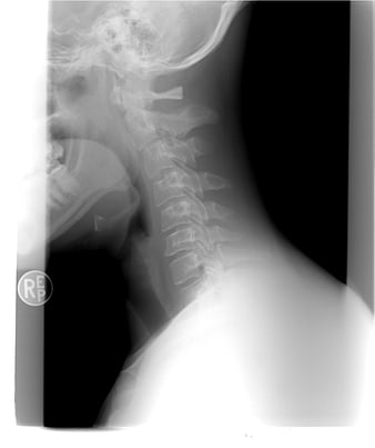 Lateral Cervical Spine X-Ray Radiograph