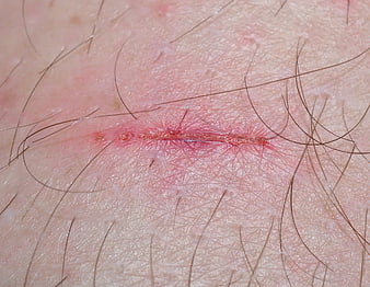 Close-up of a healing skin wound with redness and scabbing