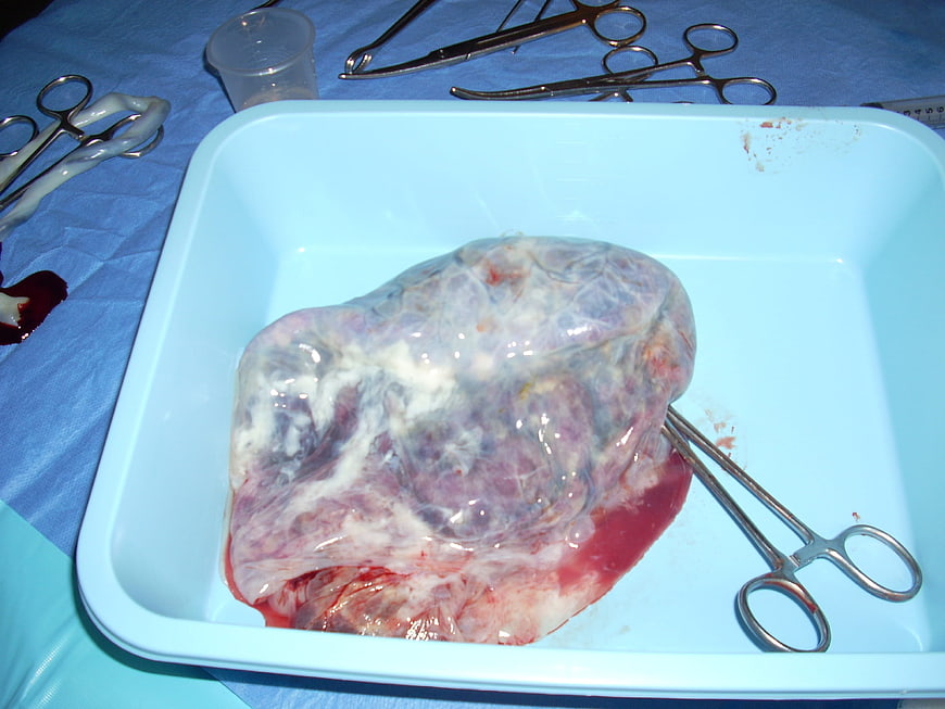Freshly delivered placenta in blue medical tray with surgical instruments