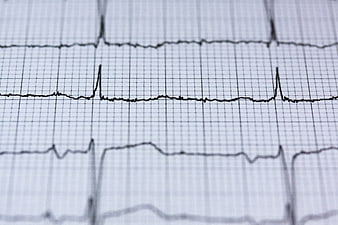 Close-up of ECG Heartbeat Graph on Grid Paper