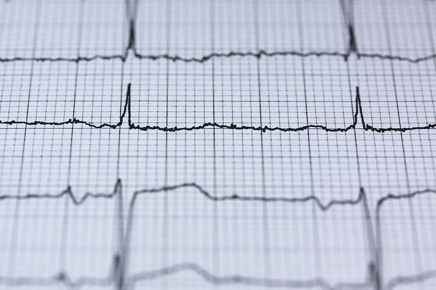 Close-up of ECG Heartbeat Graph on Grid Paper