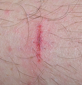 Close-up of healing skin wound with redness and hair