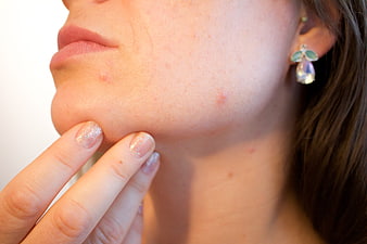 Close-up of woman touching acne on chin