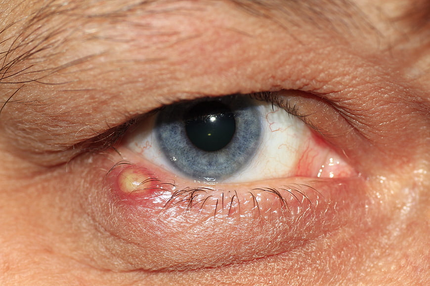 Close-up of human eye with stye and inflammation