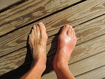Bare feet on wooden deck showing severe redness and swelling