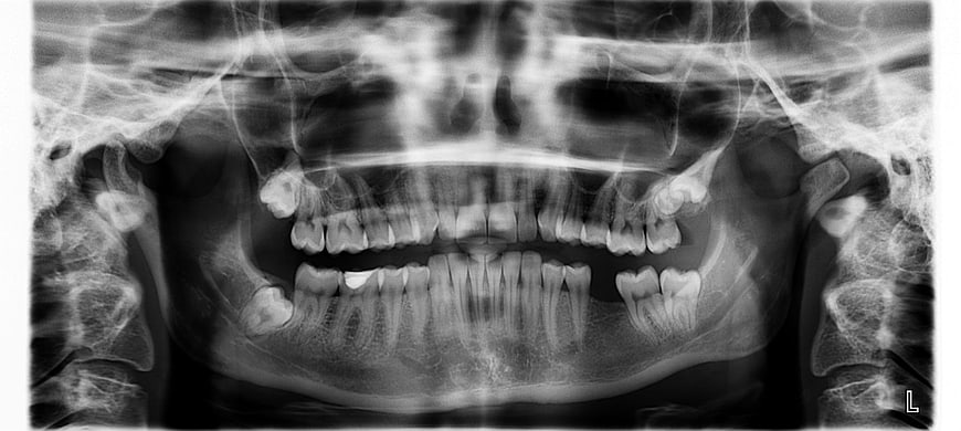 Dental X-ray showing missing lower left molar and impacted wisdom teeth